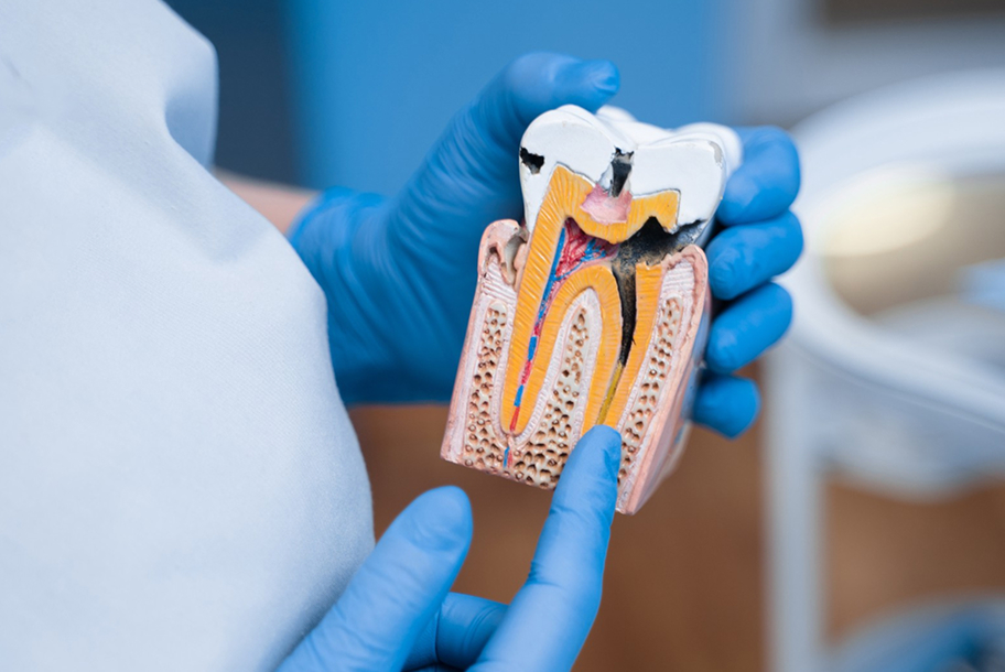 Root Canal vs. Extraction in Fullerton